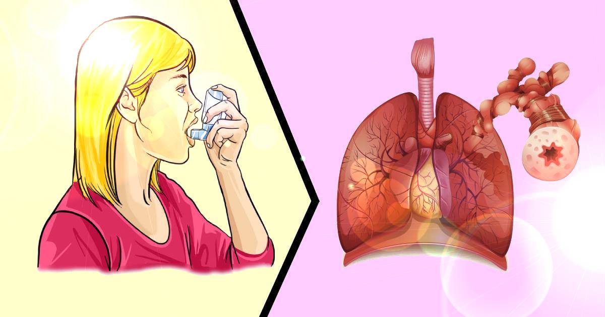 Top 5 Asthma signs and symptoms